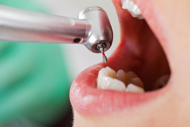 Best Chipped Tooth Repair Near Me  in South Greeley, WY